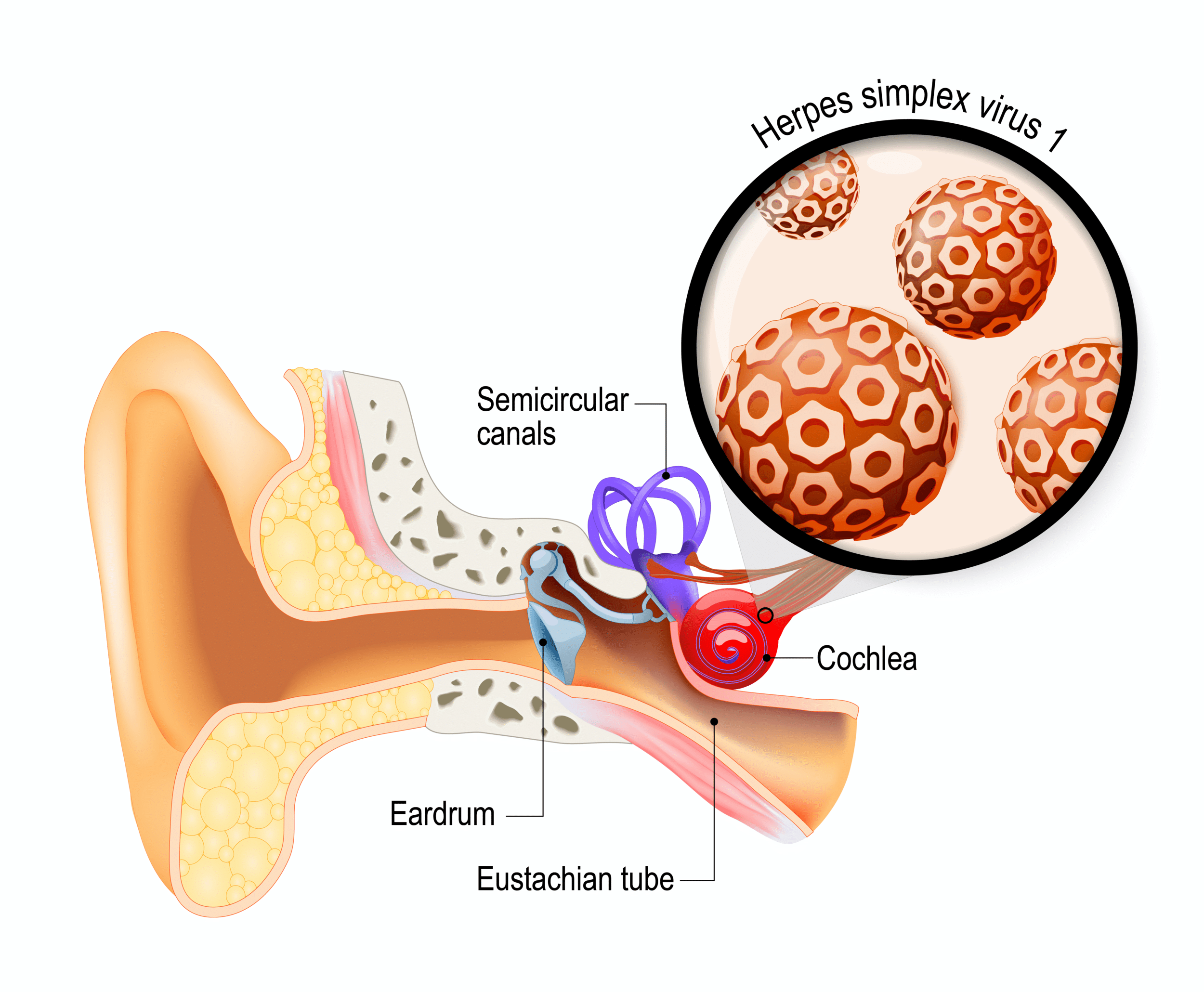 Recurring Ear Infection